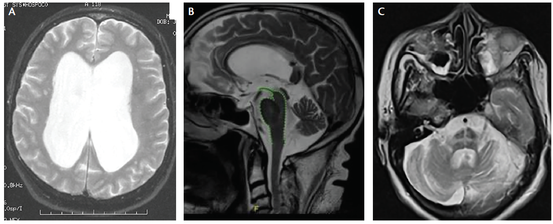 Mri Brain Scan Parkinsons Disease